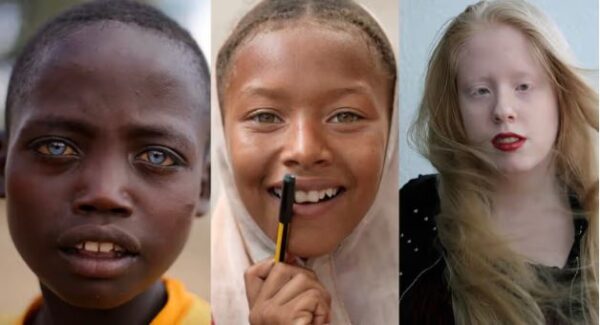 5 types of albinos and how they look