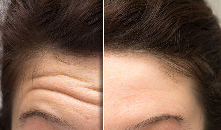 How To Get Rid Of Forehead Wrinkles